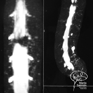 IRM Columna Lumbar Hernia Gigante T12-L1 Efecto Mielográfico