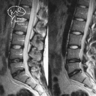 MRI Lumbar spine Degeneration Disc L4-L5-S1