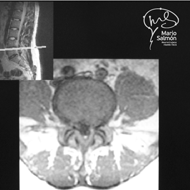MRI Lumbar with narrow channel
