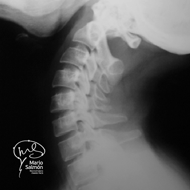 Radiografía lateral columna cervical normal