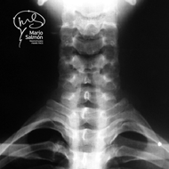 Radiografía de frente columna cervical normal