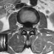IRM Columna Lumbar Axial T1 muestra disco normal