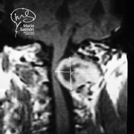 MRI Cervical Spine showing tumor between C1 and C2