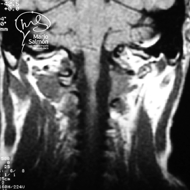 MRI Postoperative control, retired tumor of spine between C1-C2