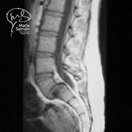 MRI Lumbar spine with displacement L5-S1