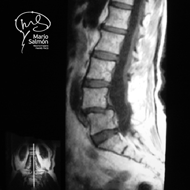 IMR Lumbar with dislocation L4-L5