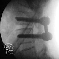 Intraoperative reduction of listhesis L4L5 X-ray