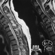 MRI Cervical Spine with C5 tumor and cord compression