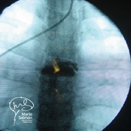 Radiografía Transoperatoria de Frente, se observa el cemento en la vertebra