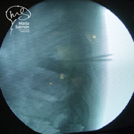 Transoperative lateral x-ray, shown the cement in the vertebra