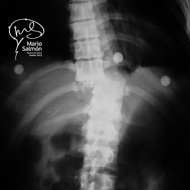 Column with traumatic injury between T10 and T11 X-ray