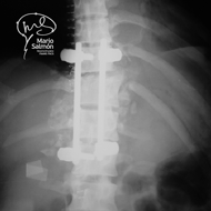 Column with traumatic injury between T10 and T11 corrected with surgery X-ray
