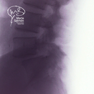 Lateral lumbar spine  dislocation L4-L5 X-ray