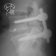 Lateral postoperative Control X-ray