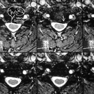 MRI Axial column Cervical herniated disc C5-C6