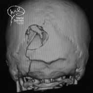 Fracture sunk Parietooccipital