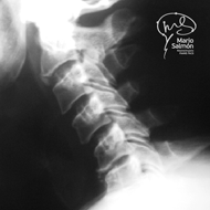 Lateral slipped disc C5-C6 X-ray
