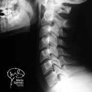 Lateral Cervical Spine in Normal Extension X-ray