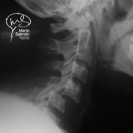 Lateral Cervical Spine dislocation C4C5 X-ray