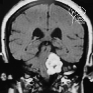 MRI Giant tumor of Left cerebellopontine angle