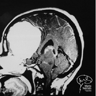MRI of skull with giant meningioma olfactory groove