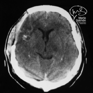 Cerebral abscess front right after surgery