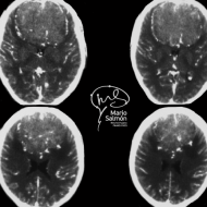 Giant meningioma olfactory groove preoperative tomography