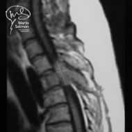 T3 spinal tumor