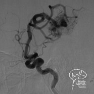 Arteriovenous malformation (angiography)