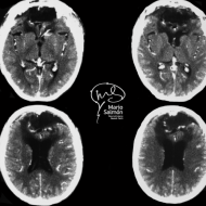 Giant meningioma olfactory groove preoperative tomography
